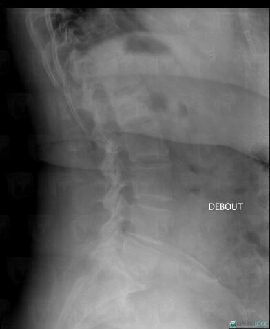 Radiology case : Paget disease (X rays ,MRI) - Diagnologic