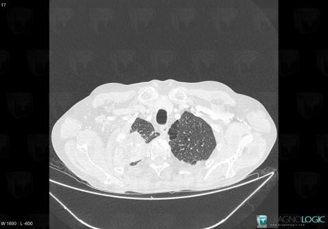 Pancoast tumor, Pulmonary parenchyma, CT