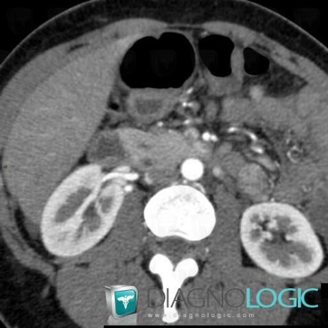 Radiology case : Pancreas divisum (CT) - Diagnologic