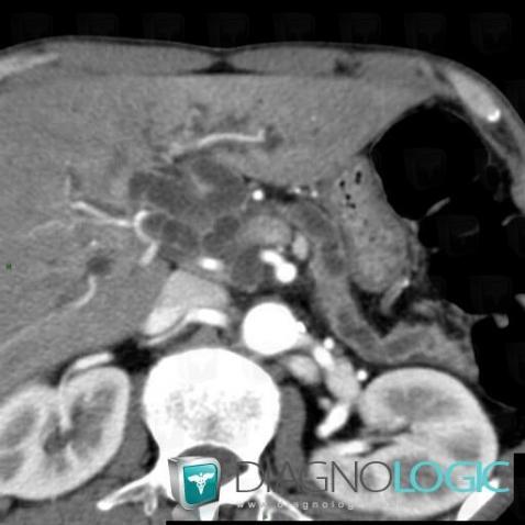 Pancreatic ductal adenocarcinoma, Intra and extra hepatic bile ducts, CT