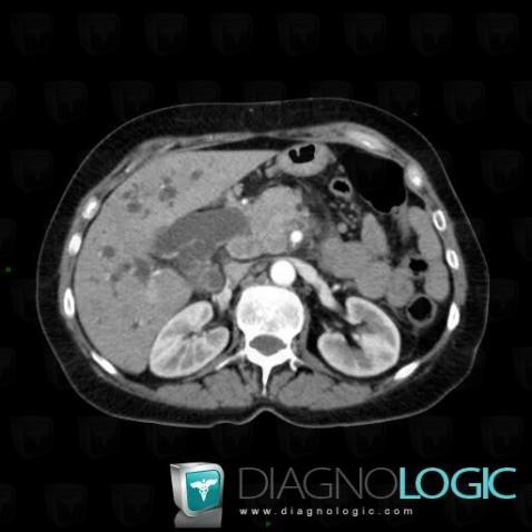 Pancreatic ductal adenocarcinoma, Intra and extra hepatic bile ducts, CT