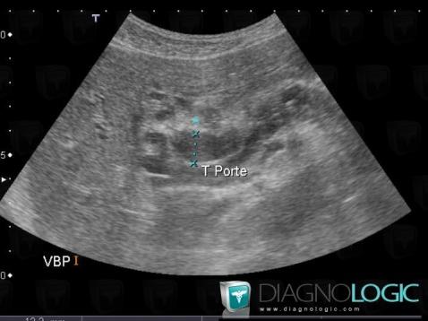 Pancreatic ductal adenocarcinoma, Intra and extra hepatic bile ducts, US