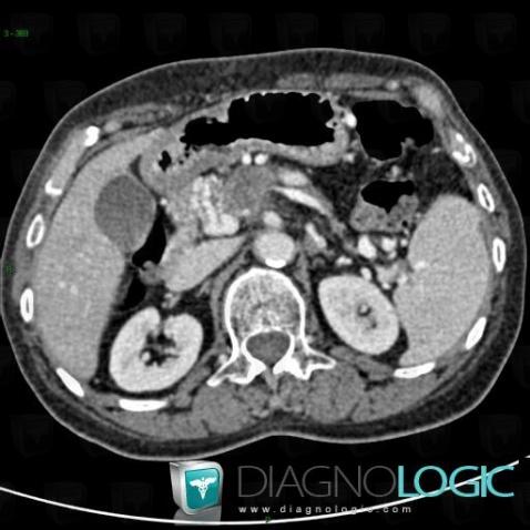 Pancreatic ductal adenocarcinoma, Pancreas, CT