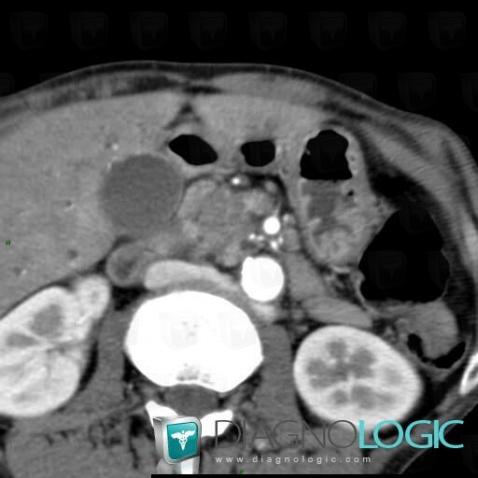 Pancreatic ductal adenocarcinoma, Pancreas, CT