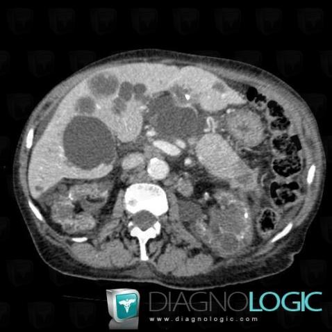 Pancreatic ductal adenocarcinoma, Pancreas, CT