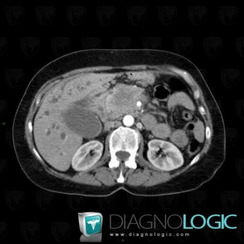 Pancreatic ductal adenocarcinoma, Pancreas, CT