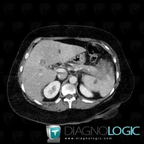 Pancreatic ductal adenocarcinoma, Pancreas, CT