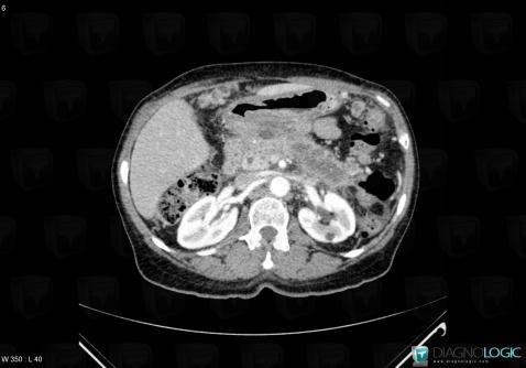 Pancreatic ductal adenocarcinoma, Pancreas, CT