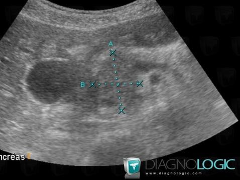 Pancreatic ductal adenocarcinoma, Pancreas, US