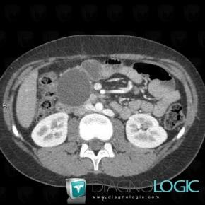 Pancreatic pseudocyst, Duodenum, CT