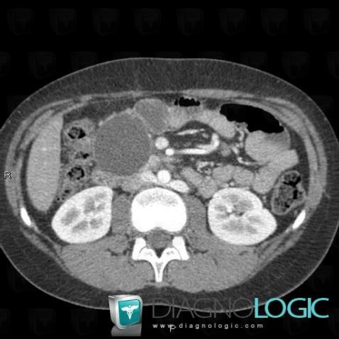 Pancreatic pseudocyst, Duodenum, CT