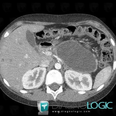 Pancreatic pseudocyst, Pancreas, Mesentery / Peritoneum, CT
