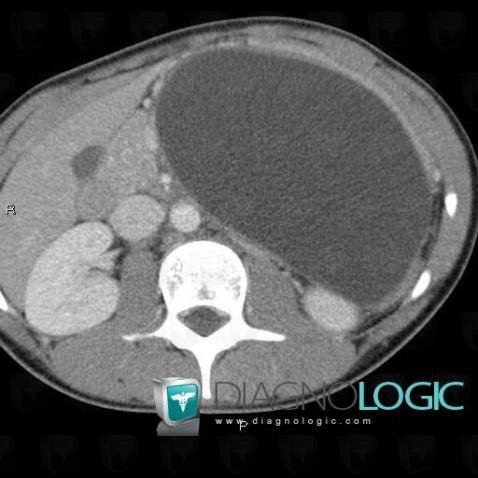 Pancreatic pseudocyst, Pancreas, Mesentery / Peritoneum, CT