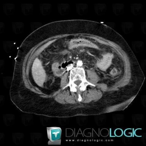 Pancreatitis, Colon, CT