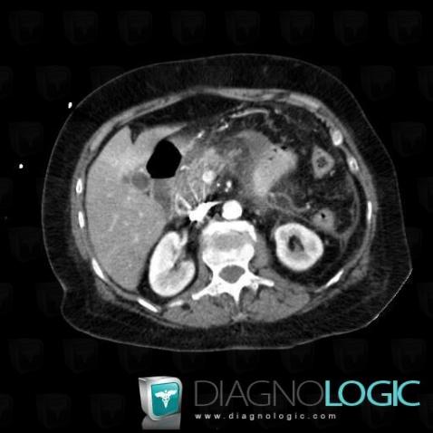 Pancreatitis, Pancreas, CT