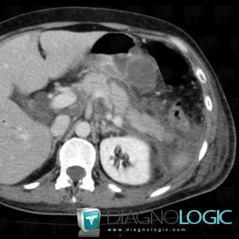 Pancreatitis, Pancreas, CT