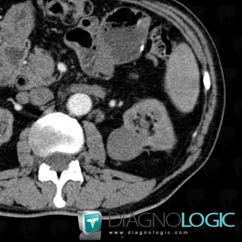 Papillary renal cell carcinoma, Kidney, CT