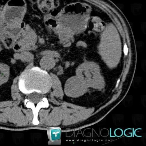 Papillary renal cell carcinoma, Kidney, CT