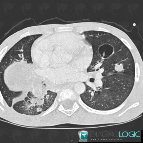 Papillomatose laryngée, Parenchyme pulmonaire, Scanner
