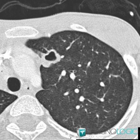 Papillomatose laryngée, Parenchyme pulmonaire, Scanner
