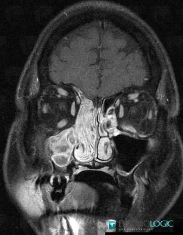 Papillome inversé, Sinus, IRM
