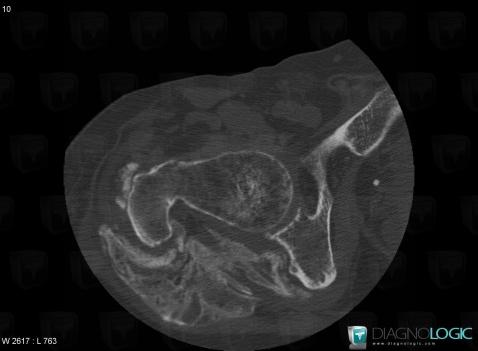 Para-Ostéo-Arthropathie-Neurogène, Articulation coxo fémorale, Autres parties molles/nerfs - Bassin, Scanner
