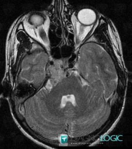 Paraganglioma, Cerebellopontine angle, Infratentorial peri cerebral spaces, MRI