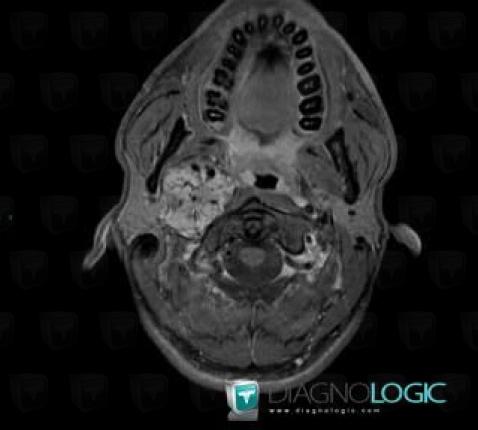 Paraganglioma, Deep facial spaces, MRI