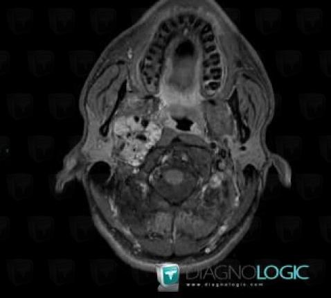 Paraganglioma, Jugular foramen, MRI