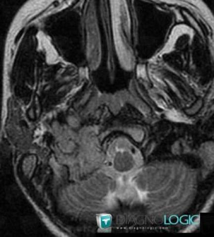 Paraganglioma, Jugular foramen, MRI