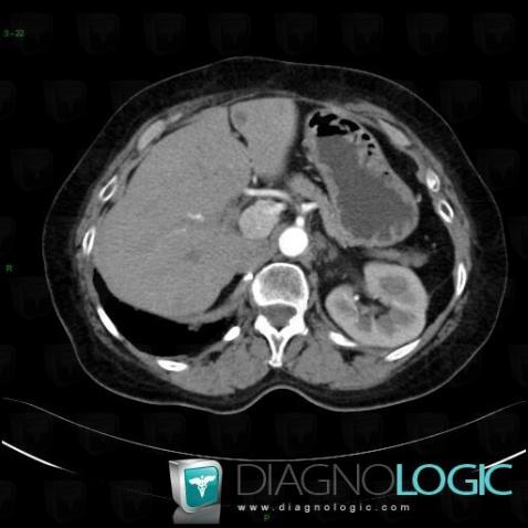 Paraganglioma, Retroperitoneum, CT