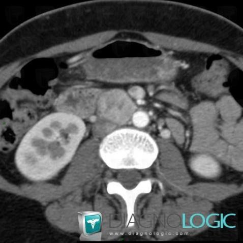 Paraganglioma, Retroperitoneum, CT