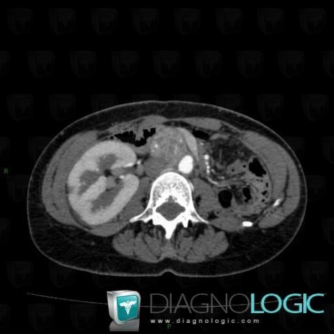 Paraganglioma, Retroperitoneum, CT