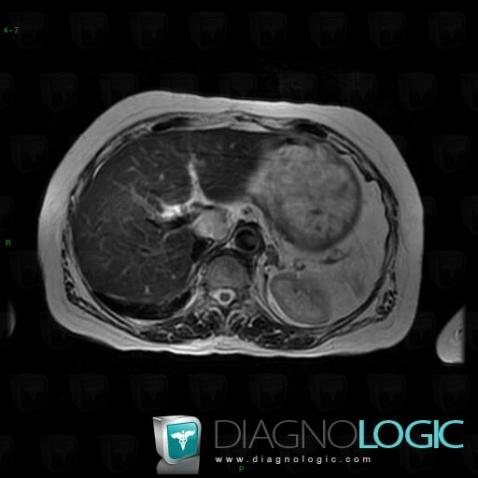 Paraganglioma, Retroperitoneum, MRI