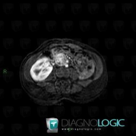 Paraganglioma, Retroperitoneum, MRI