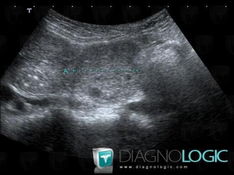 Paraganglioma, Retroperitoneum, US