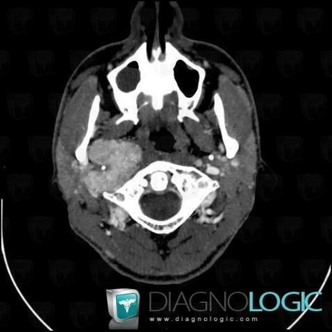 Paragangliome, Espaces profonds de-face, Scanner