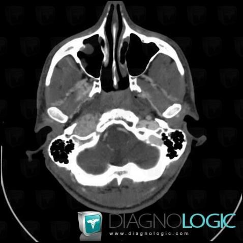 Paragangliome, Foramen jugulaire, Scanner