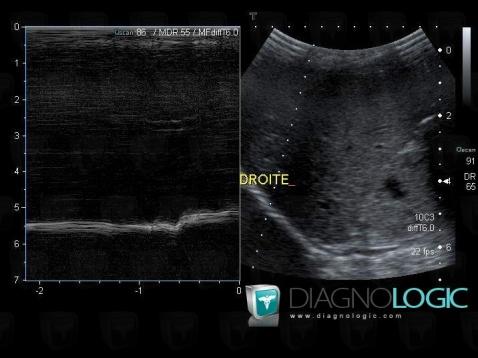 Paralysie-nerf phrénique, Diaphragme, Echographie