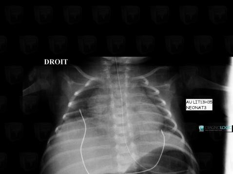 Paralysie-nerf phrénique, Diaphragme, Radio