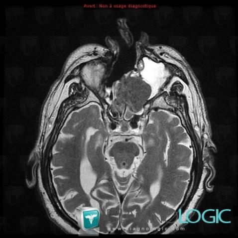 Paranasal sinus cancer, Sinus, MRI