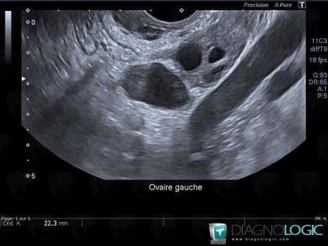 Paraovarian cyst, Adnexa / Ovary fallopian tube, US