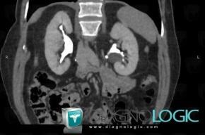 Parapelvic cyst, Kidney, CT