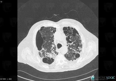 Paraseptal emphysema, Pulmonary parenchyma, CT