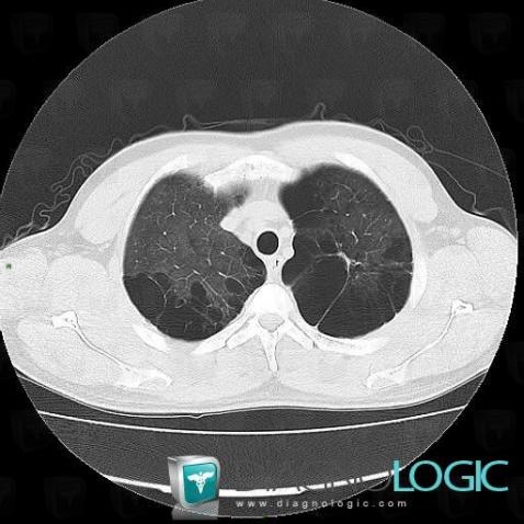 Paraseptal emphysema, Pulmonary parenchyma, CT