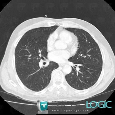 Paraseptal emphysema, Pulmonary parenchyma, CT