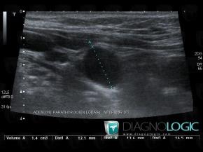 Parathroid adenoma, Thyroid / Parathyroid, US
