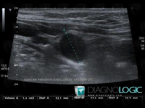 Parathroid adenoma, Thyroid / Parathyroid, US