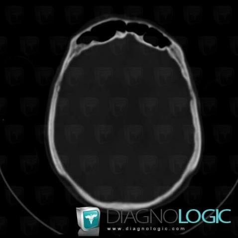 Parietal thinning, Skull vault, CT