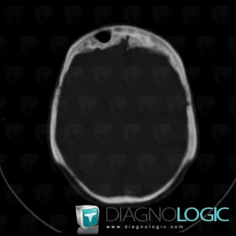 Parietal thinning, Skull vault, CT